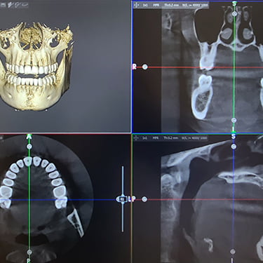 CBCT 3D X-ray