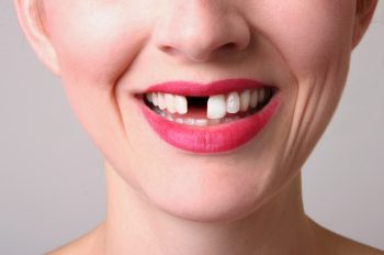 North Reading dentist, Dr. Judy Marcovici at Inertia Dental, talks about missing teeth – why you should replace them and the best ways to do so.