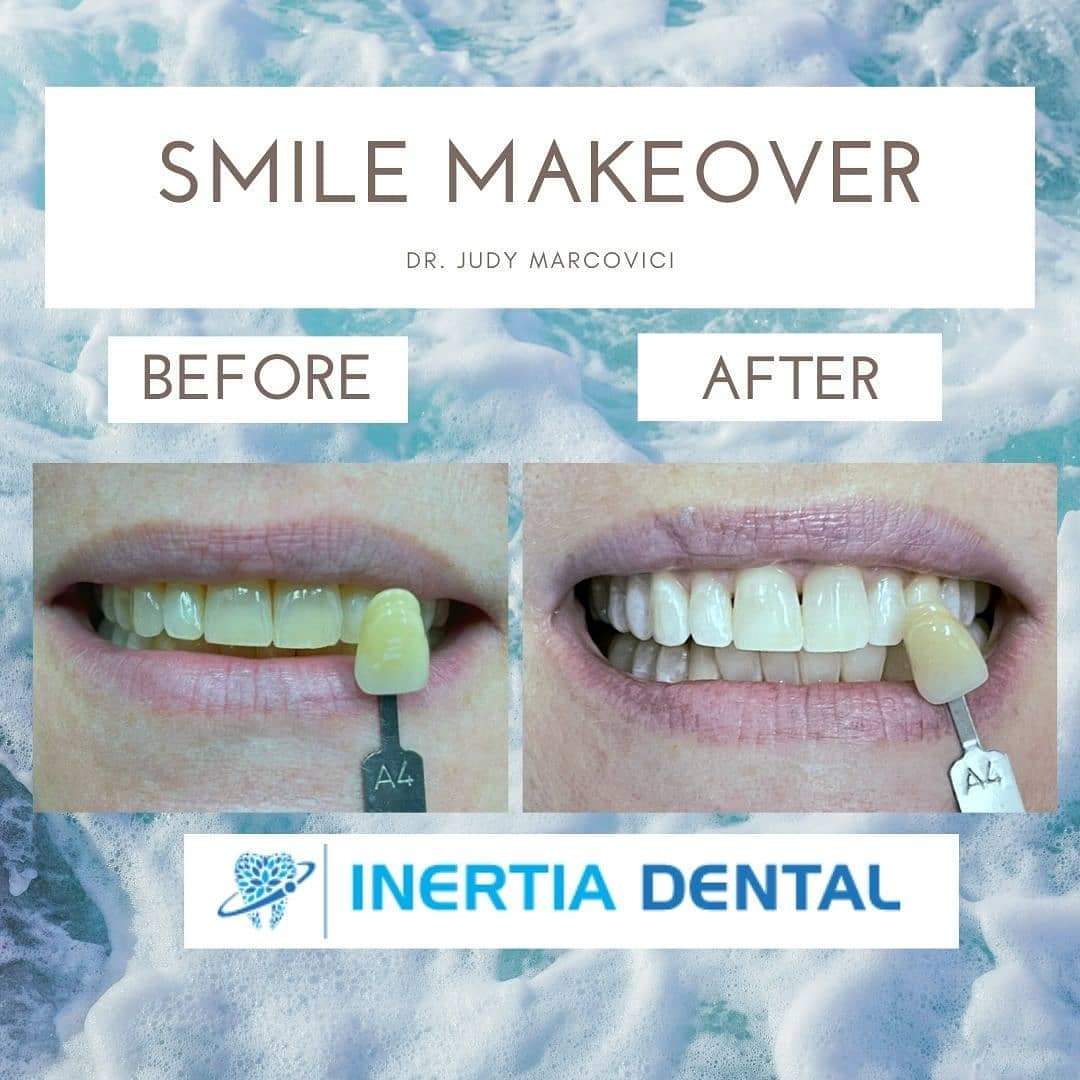 Smile Makeover Before and After