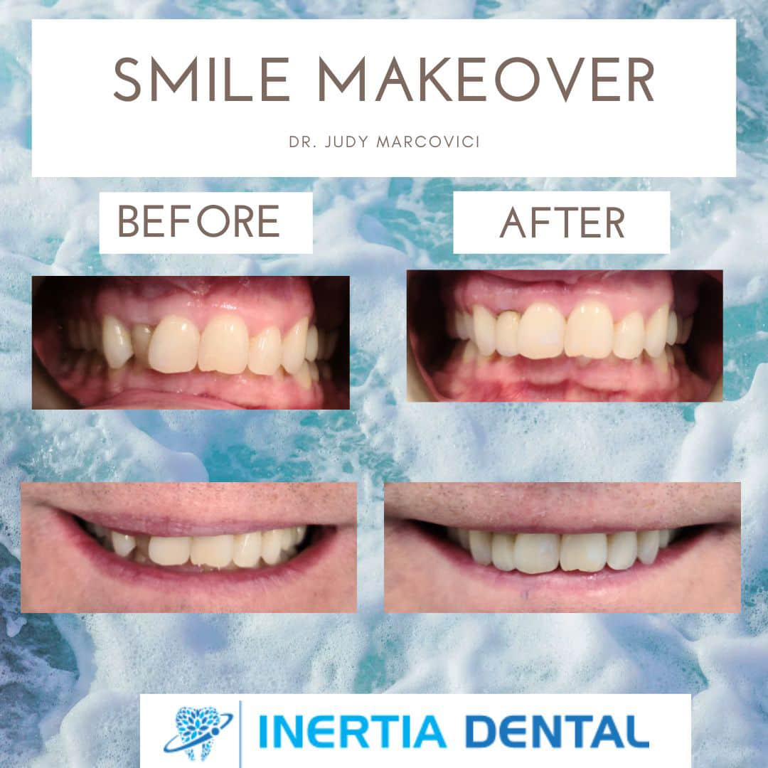 Smile Makeover Before and After