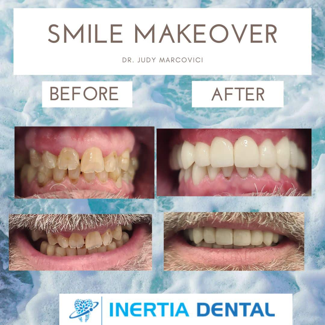 Smile Makeover Before and After