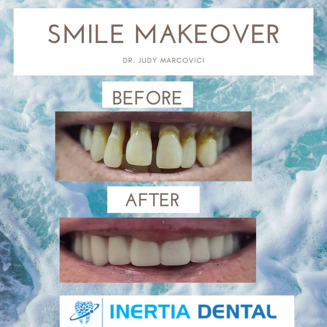 Smile Makeover Before and After