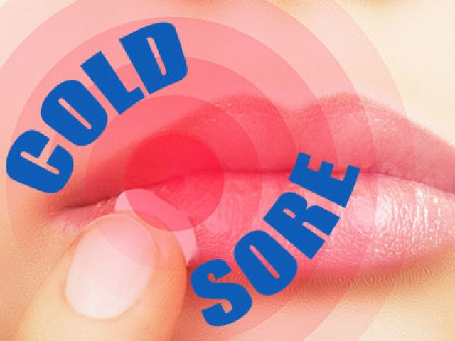 Do I Have Herpes? Cold Sores 101 (featured image)