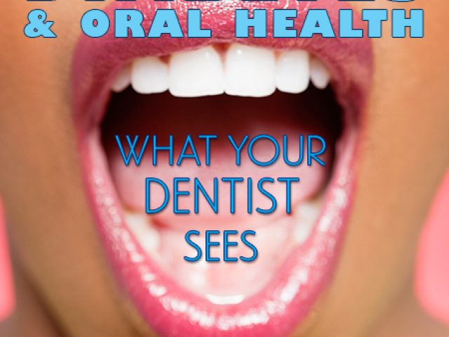 Diabetes & Oral Health: What Your Dentist Sees (featured image)