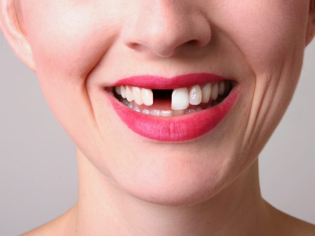 The Best Way to Replace Missing Teeth (featured image)